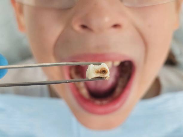 Best Broken or Chipped Tooth Repair in Dayton, VA